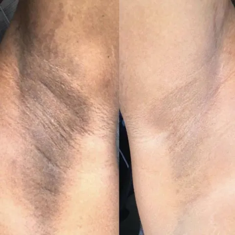 Antes e depois: axila escura à esquerda e axila mais clara à direita
